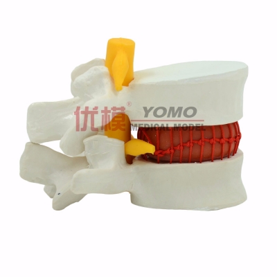 腰椎間盤(pán)突出演示模型
